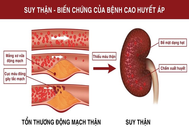 Bài thuốc kinh nghiệm phòng trị cao huyết áp. - Ảnh 2.