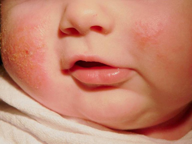 Vaccine phòng bệnh lao có khả năng làm giảm bệnh eczema ở trẻ sơ sinh - Ảnh 3.