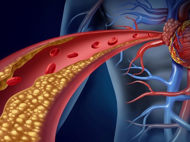 6 dấu hiệu của cơ thể báo động cholesterol máu cao - Ảnh 1.