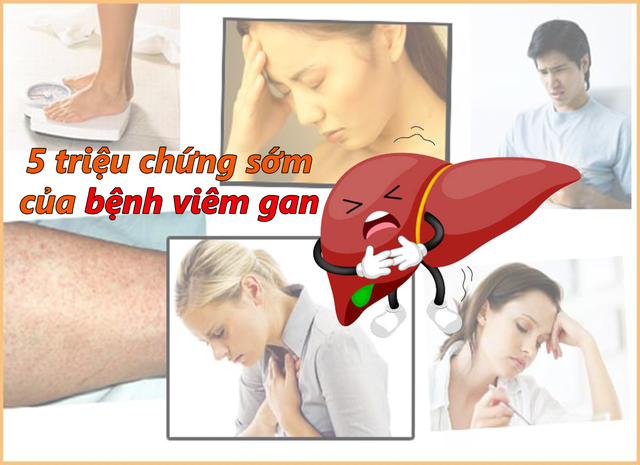 5 triệu chứng sớm của viêm gan và gợi ý hỗ trợ gan phục hồi - Ảnh 1.