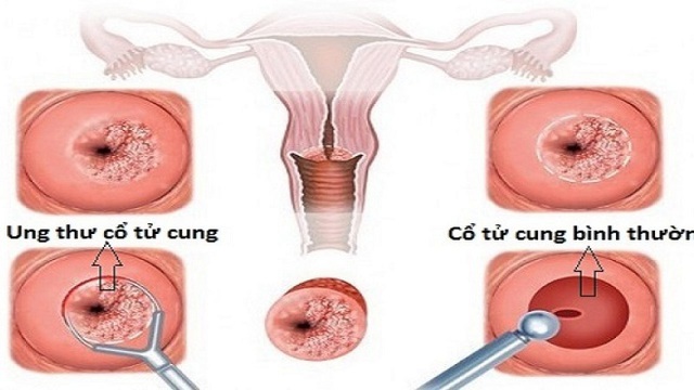  tầm soát ung thư cổ tử cung 