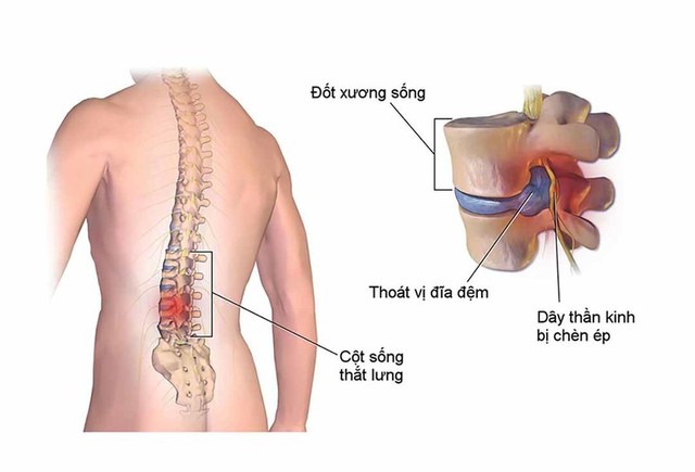 Hội chứng đau thắt lưng: Nguyên nhân, triệu chứng và cách điều trị - Ảnh 2.