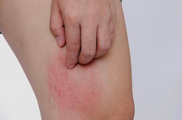 Viêm khớp vảy nến ở trẻ em và cách điều trị - Ảnh 2.