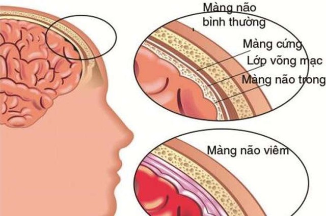 Bệnh động kinh: Cách nhận biết, xử trí và những điều nên tránh - Ảnh 3.