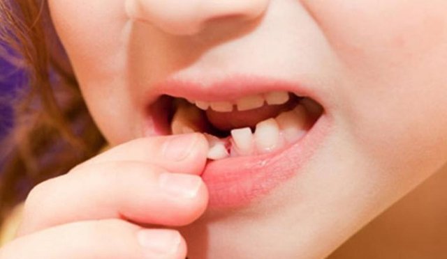 Chăm sóc răng cho trẻ ở độ tuổi thay răng - Ảnh 2.