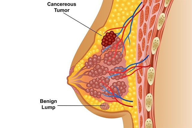 Sàng lọc ung thư vú sớm với chi phí ưu đãi trong tháng 10 - Ảnh 1.