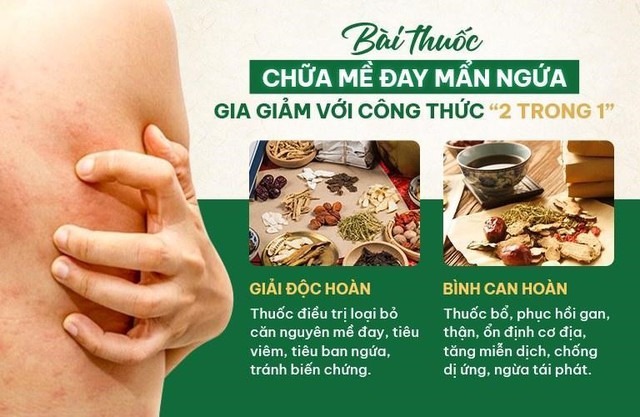 Địa chỉ chữa mề đay bằng Đông y uy tín, chất lượng - Ảnh 2.