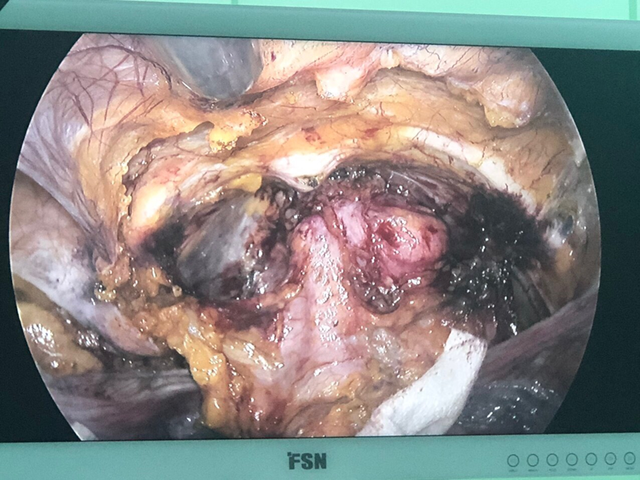 Phẫu thuật nội soi điều trị 6 mặt bệnh sàn chậu trở thường quy tại Bệnh viện đa khoa TP Vinh - Ảnh 5.