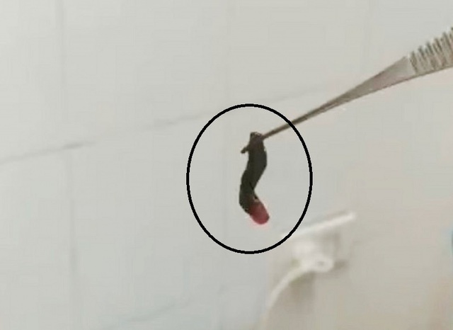 Quảng Ninh: Chảy máu cam đi khám, phát hiện con vắt dài 2cm ở trong mũi - Ảnh 1.