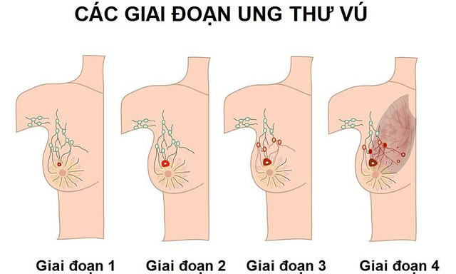 Ung thư vú có yếu tố di truyền nhưng bạn hoàn toàn có thể phòng ngừa được bằng thay đổi lối sống - Ảnh 3.