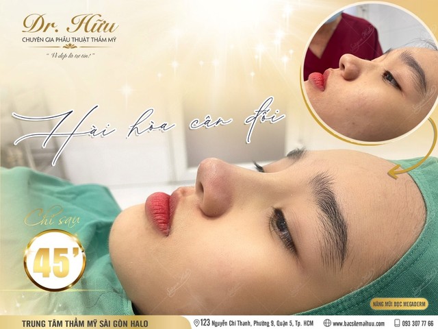 Nâng mũi đẹp tự nhiên bởi bác sĩ thẩm mỹ Lê Mai Hữu - Ảnh 2.