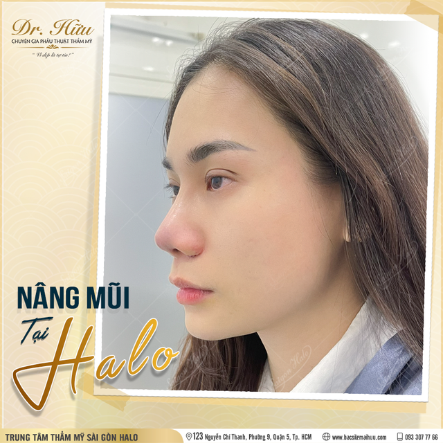 Nâng mũi đẹp tự nhiên bởi bác sĩ thẩm mỹ Lê Mai Hữu - Ảnh 3.