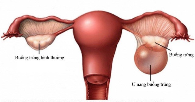 Chuyên gia cảnh báo phụ nữ mang thai không nên chủ quan với u buồng trứng - Ảnh 4.