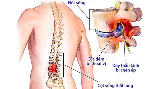 Thoát vị đĩa đệm cột sống thắt lưng: Nhận biết mức độ ở các giai đoạn của bệnh - Ảnh 1.