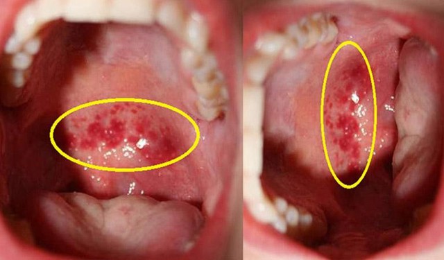 Viêm họng mạn tính là gì? Dấu hiệu và cách phòng ngừa, điều trị - Ảnh 1.