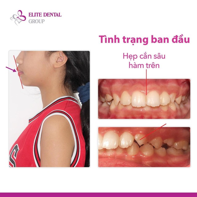 Phương pháp niềng răng cho trẻ em nhẹ nhàng, ít đau - Ảnh 2.