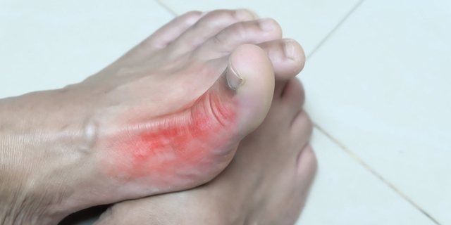 Người bệnh Gout có nên uống cà phê? - Ảnh 2.