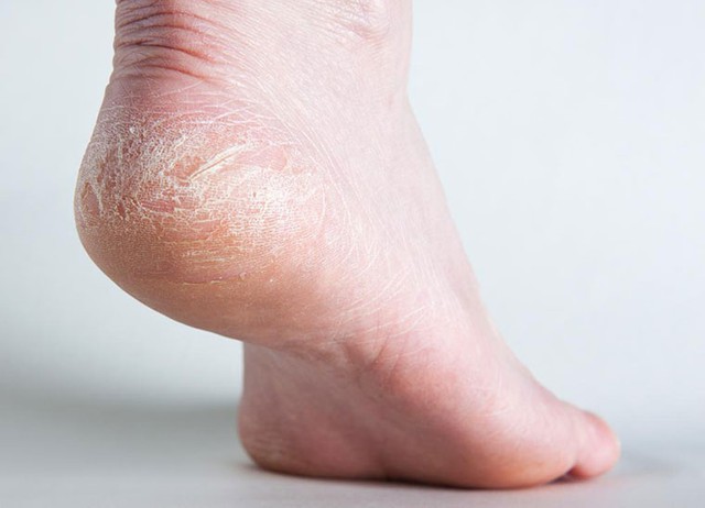 Cách chăm sóc gót chân khô, nứt nẻ trong mùa lạnh - Ảnh 2.