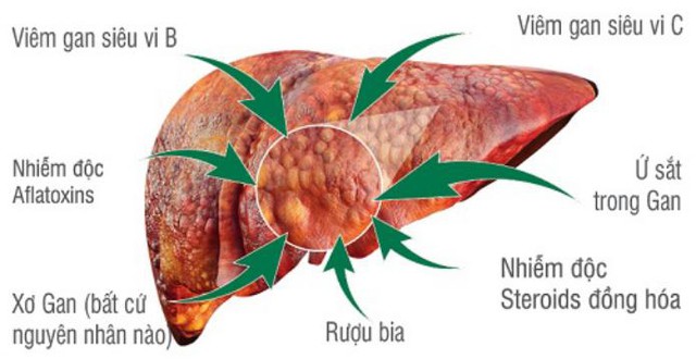 Vàng da ở người lớn bệnh gì? - Ảnh 2.