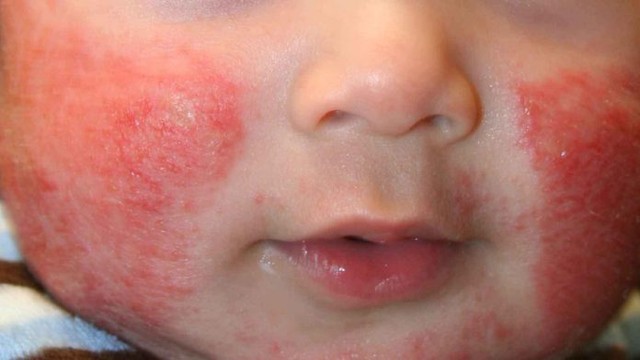 Kem dưỡng ẩm da có giúp ngăn ngừa bệnh chàm ở trẻ sơ sinh? - Ảnh 1.