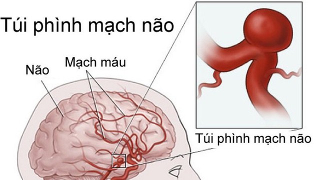 Phình mạch máu não có thể gây đột quỵ và ai là đối tượng nguy cơ ? - Ảnh 1.