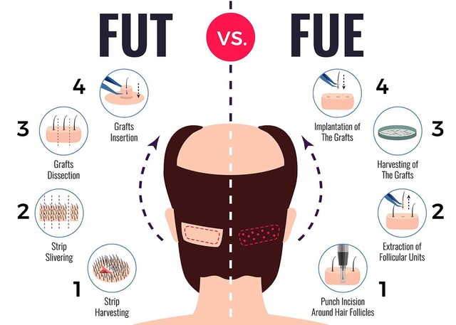 Cấy tóc tự thân: giải đáp các câu hỏi thường gặp từ chuyên gia - Ảnh 2.