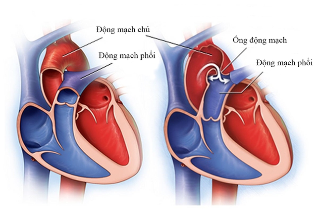 Còn ống động mạch ở trẻ: Triệu chứng, nguyên nhân và những lưu ý - Ảnh 2.