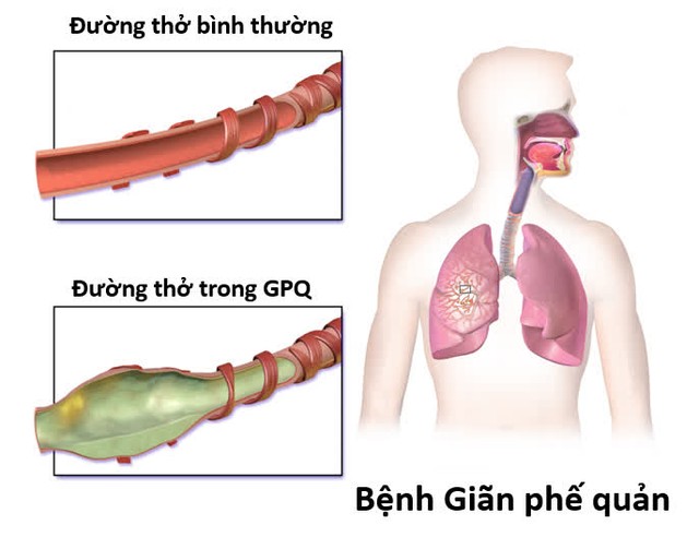 Ho, khạc đờm kéo dài,... cảnh giác với giãn phế quản - Ảnh 1.