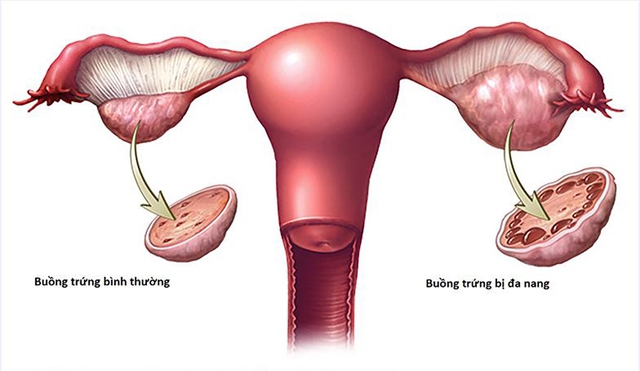 Biện pháp kiểm soát sinh sản tốt nhất cho phụ nữ bị buồng trứng đa nang - Ảnh 1.