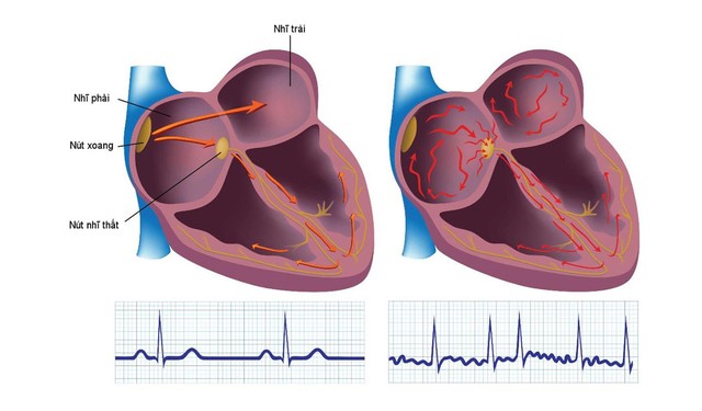 Một số rối loạn nhịp tim thường gặp và dấu hiệu nhận biết - Ảnh 6.