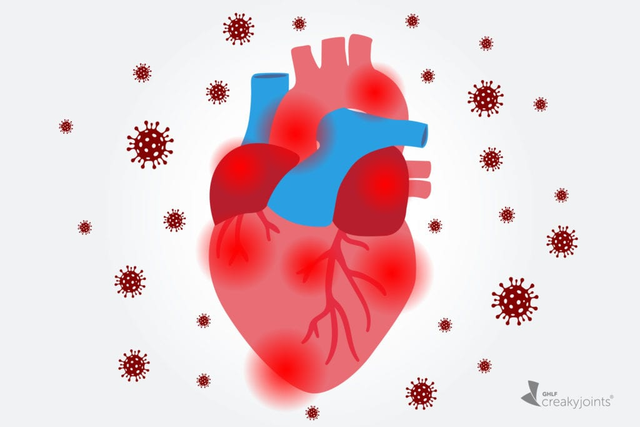 Di chứng tim mạch hậu F0 làm thế nào để hỗ trợ giảm nhẹ? - Ảnh 1.