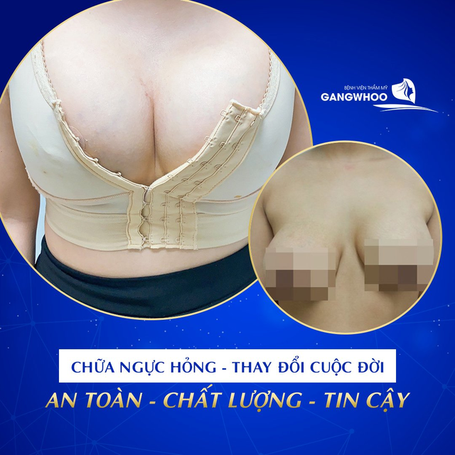 Sửa ngực hỏng uy tín, công nghệ Hàn Quốc BVTM Gangwhoo - Ảnh 2.