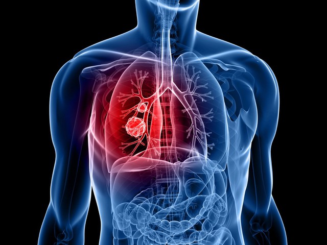 Ung thư phổi: Nguyên nhân, yếu tố nguy cơ gây bệnh và điều trị - Ảnh 2.