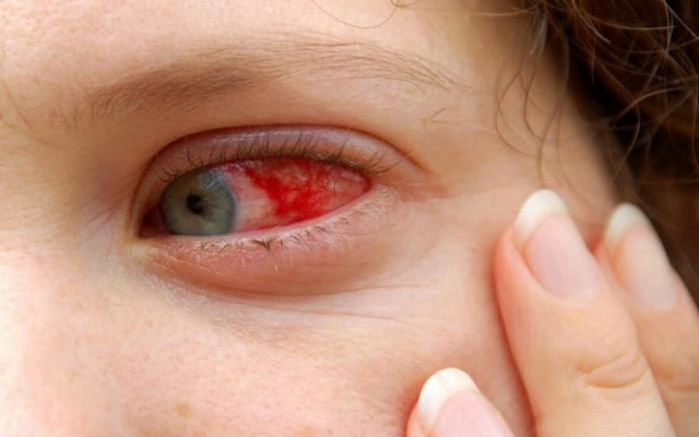 COVID-19 gây ảnh hưởng đến mắt như thế nào? - Ảnh 2.