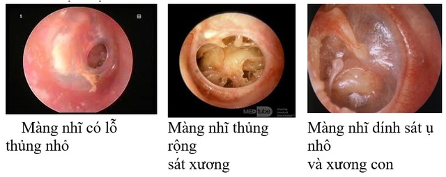 Viêm tai giữa mạn tính ở người lớn – Những vấn đề cần lưu ý - Ảnh 3.