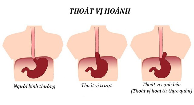 Thoát vị hoành bẩm sinh: Biểu hiện, nguyên nhân và điều trị - Ảnh 2.