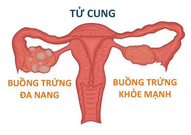 7 nguyên nhân chính dẫn đến vô sinh ở nữ - Ảnh 4.