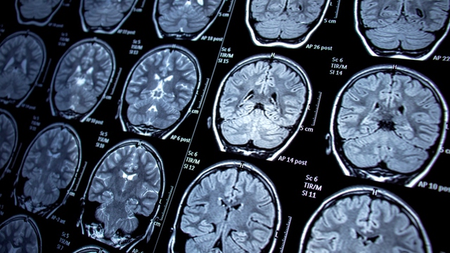 Nghiên cứu mới: Mắc COVID-19 nhẹ cũng gây thay đổi trong não bộ - Ảnh 2.