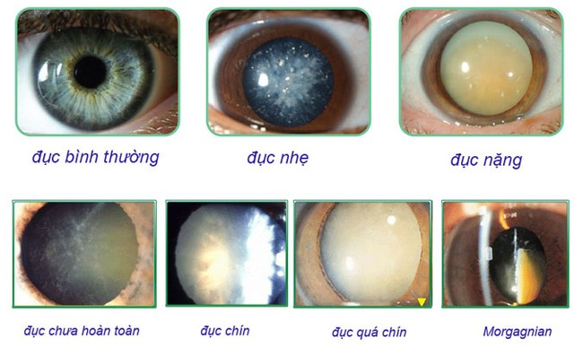 Cách chăm sóc mắt sau mổ đục thủy tinh thể ở người cao tuổi - Ảnh 1.