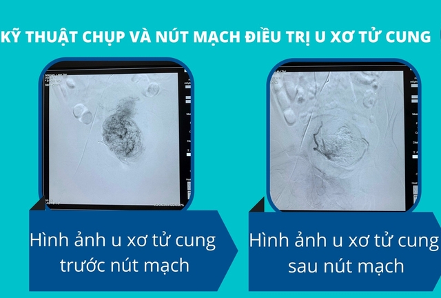 BVĐK tỉnh Bình Dương lần đầu tiên thực hiện kỹ thuật chụp và nút mạch điều trị u xơ tử cung - Ảnh 1.