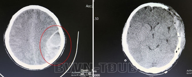 Chấn thương vùng đầu, chủ quan không đi khám nam thanh niên rơi vào hôn mê sâu - Ảnh 1.