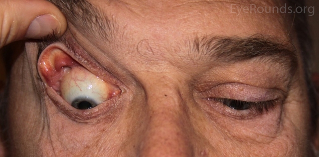 Sụp mí kèm khó chịu mắt thường xuyên: Có thể bạn mắc Hội chứng nhẽo mi - Ảnh 3.