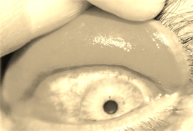 Sụp mí kèm khó chịu mắt thường xuyên: Có thể bạn mắc Hội chứng nhẽo mi - Ảnh 4.