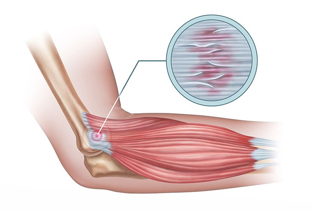 Viêm lồi cầu ngoài xương cánh tay: Nguyên nhân, điều trị và phòng ngừa  - Ảnh 2.
