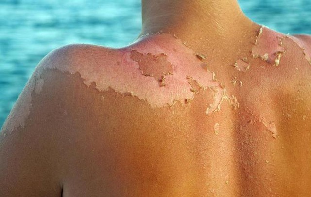 Tác hại của nắng với làn da và cách chống nắng toàn diện cho cơ thể - Ảnh 1.
