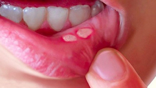 Những triệu chứng cơ bản của loét miệng áp tơ là gì?
