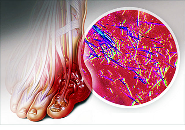 Dấu hiệu nhận biết gout cấp và cách điều trị - Ảnh 2.