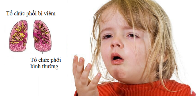 Có cần tái khám khi điều trị viêm phổi ở trẻ em không? - Ảnh 2.