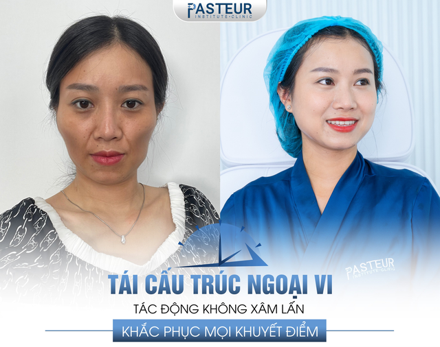 Công nghệ tái cấu trúc ngoại vi giúp khuôn mặt đầy đặn và cân đối - Ảnh 2.