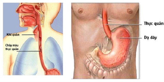 Giãn tĩnh mạch thực quản và xơ gan rất nguy hiểm làm thế nào để phát hiện sớm và dự phòng? - Ảnh 1.